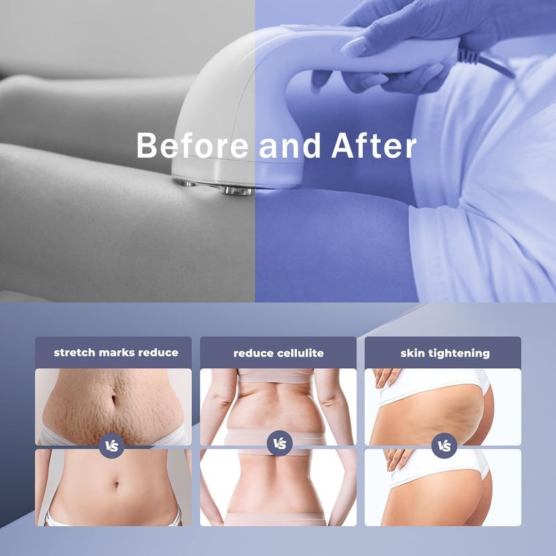 Pakerler Radio Frequency Induced Heat-Palm NRG Cellulite Body Device - Image 5
